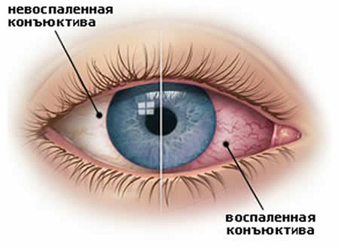 Можно ли носить контактные линзы при конъюнктивите? - linza.com.ua